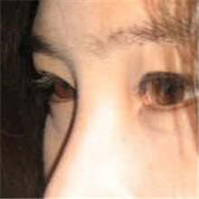 分享我的雙眼皮+開內(nèi)眼角+切除鼻中隔軟骨整形手術(shù)恢復(fù)經(jīng)歷~