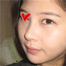 分享我的雙眼皮+開內(nèi)眼角+切除鼻中隔軟骨整形手術(shù)恢復(fù)經(jīng)歷~