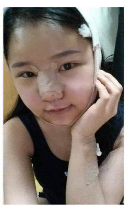 做了下頜角整形手術(shù) 大臉貓變成巴掌臉果還不錯(cuò)哦