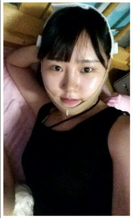 做了下頜角整形手術(shù) 大臉貓變成巴掌臉果還不錯(cuò)哦