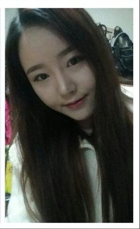 做了下頜角整形手術(shù) 大臉貓變成巴掌臉果還不錯(cuò)哦