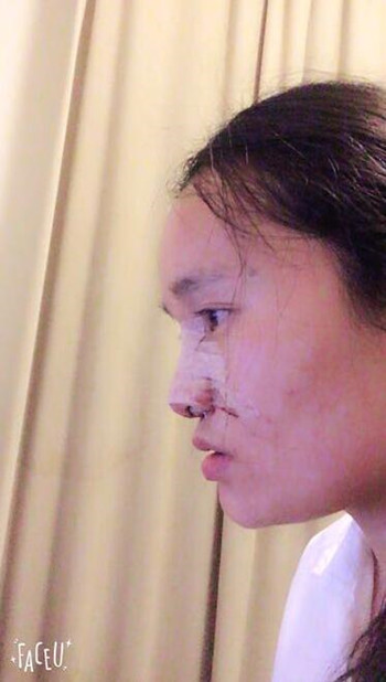 做了隆鼻整形手術(shù)整個(gè)鼻子靈巧了許多 快來圍觀果