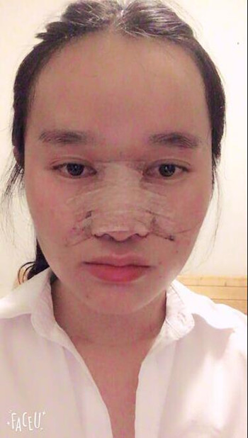 做了隆鼻整形手術(shù)整個(gè)鼻子靈巧了許多 快來圍觀果