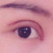 全切雙眼皮和開(kāi)眼角