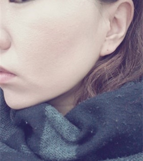 電波l皮緊膚除皺，的確是年輕了不少