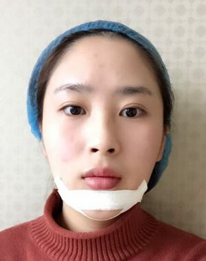 深圳美萊整形醫(yī)院做了進(jìn)口硅膠墊下巴臉型都變好看了