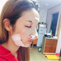 去年做的鷹鉤鼻矯正+面部脂肪填充，分享術(shù)后照片~