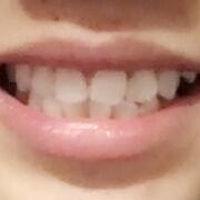 美容冠牙齒修復(fù)，緩解前后過(guò)程分享