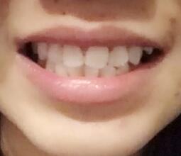 牙齒整形美容冠