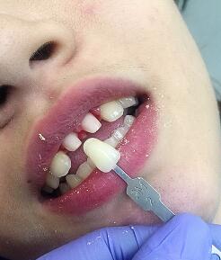 氧化鋯烤瓷牙價(jià)格5600元兩顆