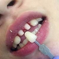 氧化鋯烤瓷牙價(jià)格5600元兩顆，果很滿意