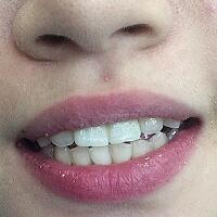 氧化鋯烤瓷牙價(jià)格5600元兩顆，果很滿意