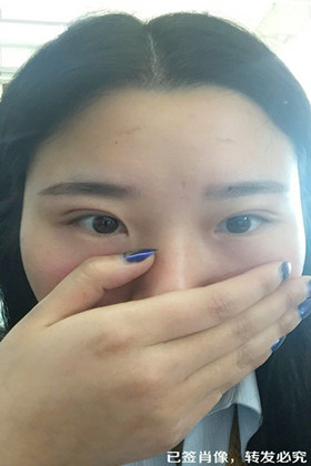 剛做了雙眼皮切開重瞼手術，恢復得越來越自然了