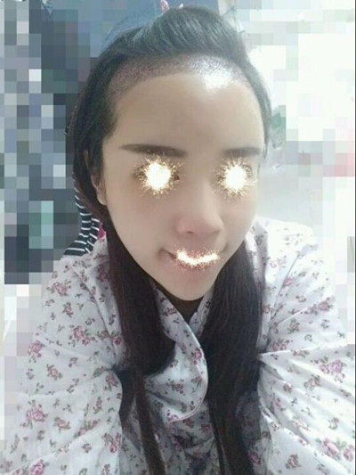 植發(fā)拯救了我的高發(fā)際線 果很棒哦**