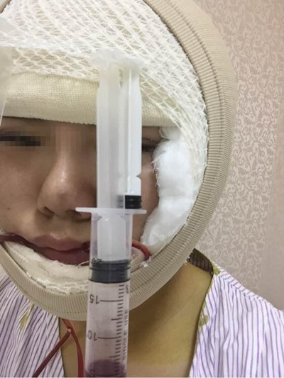 磨骨手術(shù)讓我變成小v臉 果真的很不錯(cuò)