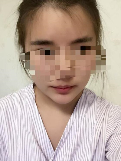 磨骨手術(shù)讓我變成小v臉 果真的很不錯(cuò)