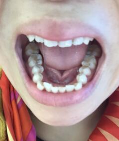 牙齒正畸緩解前圖片