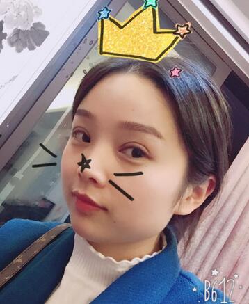 全切雙眼皮1個(gè)月過程圖