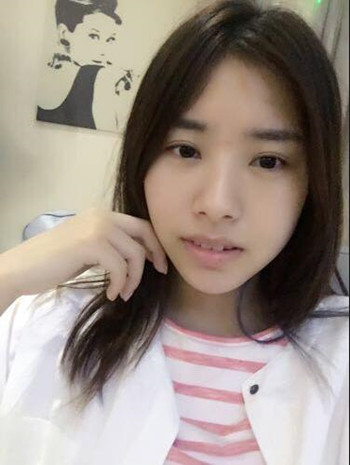 玻尿酸豐下巴果還不錯(cuò) 過(guò)幾個(gè)月就做假體隆下巴