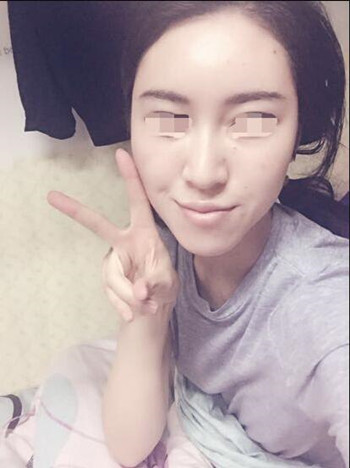 給大家分享一下我的自體脂肪填充全臉經(jīng)歷 內(nèi)有果對(duì)比圖