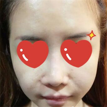 做音波拉皮除皺術(shù)一個月了，分享恢復(fù)過程和前后對比果圖片~