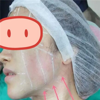 做音波拉皮除皺術(shù)一個月了，分享恢復(fù)過程和前后對比果圖片~