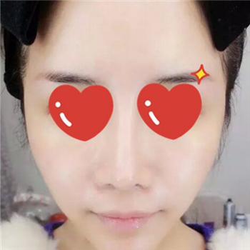 做音波拉皮除皺術(shù)一個月了，分享恢復(fù)過程和前后對比果圖片~