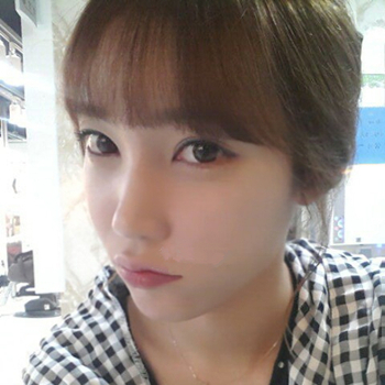 長(zhǎng)沙美萊做了磨顴骨手術(shù)，分享恢復(fù)過程和前后對(duì)比果圖片~