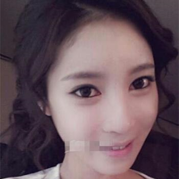 長(zhǎng)沙美萊做了磨顴骨手術(shù)，分享恢復(fù)過程和前后對(duì)比果圖片~