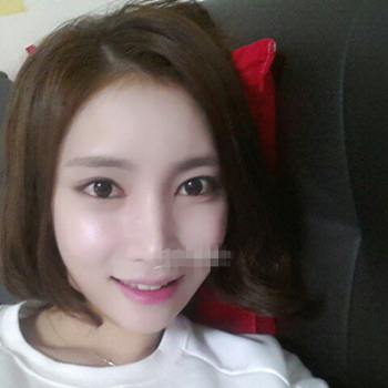 長(zhǎng)沙美萊做了磨顴骨手術(shù)，分享恢復(fù)過程和前后對(duì)比果圖片~