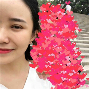 北京美萊做了雙眼皮手術(shù)，分享前后對(duì)比果圖片~