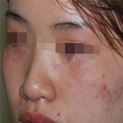 內(nèi)切去眼袋手術(shù)恢復(fù)過程和前后對比果圖片分享，美聯(lián)臣做的哦~