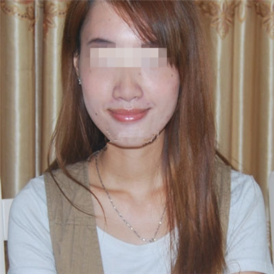 內(nèi)切去眼袋手術(shù)恢復(fù)過程和前后對比果圖片分享，美聯(lián)臣做的哦~