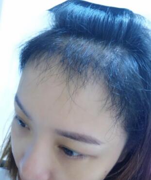 植發(fā)有五個(gè)月了