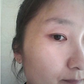真人記錄了彩光嫩膚前后過程，果真的還不錯(cuò)