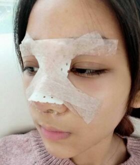 隆鼻整形日記，像變了個(gè)人似的