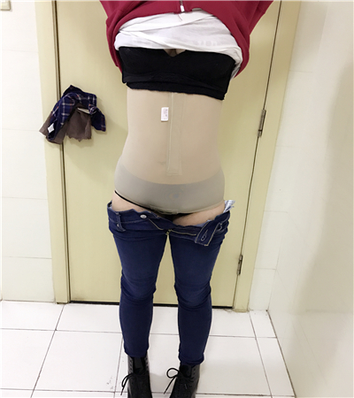 分享我的吸脂瘦腰腹手術(shù)經(jīng)歷，還有前后的照片哦~