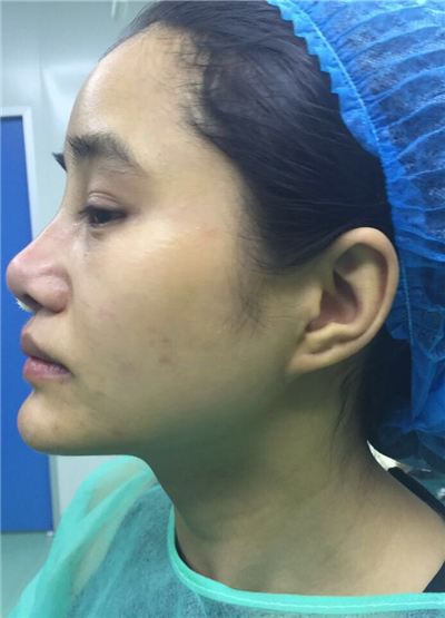 我做自體脂肪隆鼻手術(shù)恢復(fù)過程和前后對(duì)比果圖片分享哦~