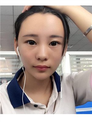 做了全臉自體脂肪填充你們覺得好看嗎