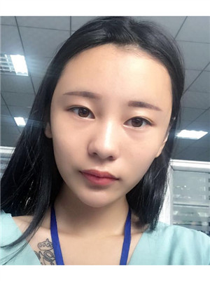 做了全臉自體脂肪填充你們覺得好看嗎