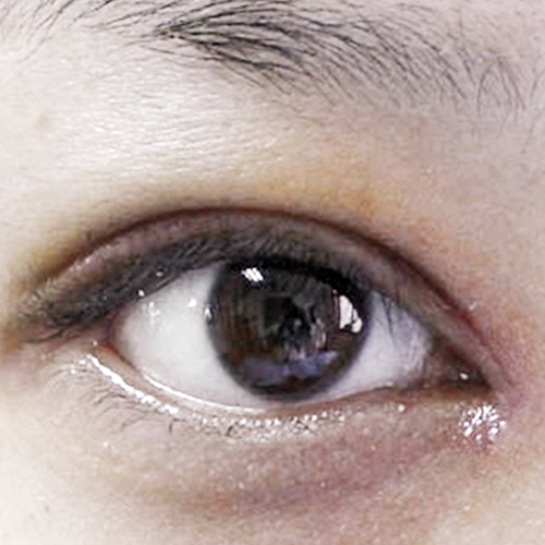 米蘭柏羽做了外切去眼袋，分享手術(shù)前后對(duì)比果圖片哦~