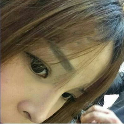 玻尿酸注射隆鼻三個(gè)月了，分享術(shù)后恢復(fù)照片哇~