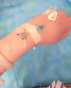 吸脂手術(shù)之后便在躺著輸液