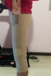 大腿吸脂減肥第5天了