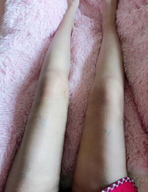 大腿吸脂手術(shù)后一直沒有洗腿,不敢洗,怕傷口感染