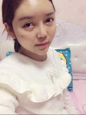 做了自體脂肪填充全臉果還不錯(cuò) 現(xiàn)在請叫元?dú)馍倥? /> </a>
<a href=