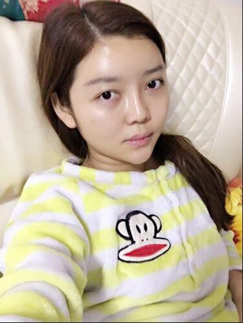 做了自體脂肪填充全臉果還不錯(cuò) 現(xiàn)在請叫元?dú)馍倥? /> </a>
<a href=