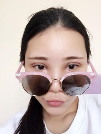 我的自體脂肪豐額頭+豐臉頰+雙眼皮+開眼角的真實(shí)經(jīng)歷 還有果圖哦