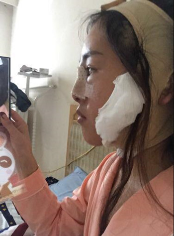 我在南昌佳美做的隆鼻整形+光纖溶脂去雙下巴 果真的很不錯(cuò)