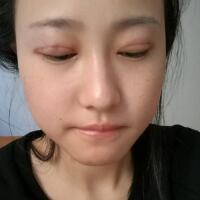 割雙眼皮恢復(fù)過程分享，整形價格3800元